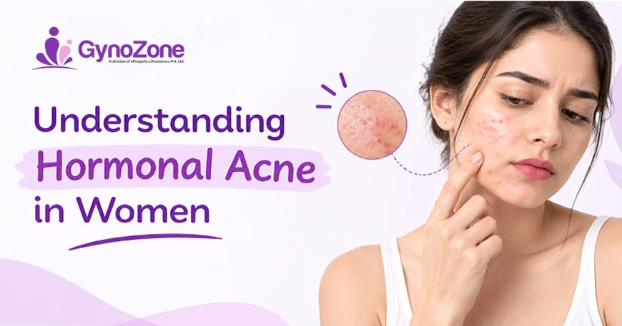 Hormonal Acne in Women Causes and Treatment